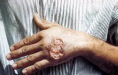 Thái Lan cảnh báo bệnh nhiễm ký sinh trùng Leishmania gây tử vong