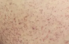 Cảnh báo dấu hiệu trở nặng ở trẻ mắc sốt xuất huyết