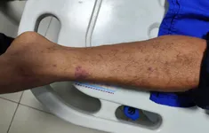 Tăng cường giám sát bệnh não mô cầu tại phía Nam