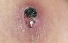 Phát hiện một ca mắc giun rồng tại Phú Thọ
