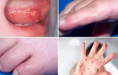 TP Hồ Chí Minh: Ca mắc tay chân miệng tăng trở lại trong tuần 18