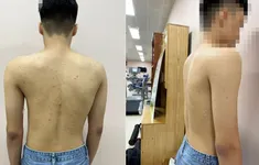 Khám miễn phí gù, vẹo cột sống cho trẻ dưới 18 tuổi