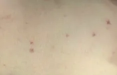 Bà Rịa - Vũng Tàu: Bé trai 3 tuổi tử vong do não mô cầu