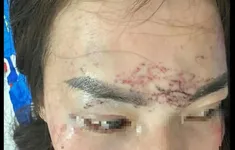 Khởi tố vụ án người phụ nữ bị tạt axit, xăm lên mặt do ghen tuông