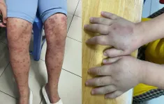 Cẩn trọng với ban xuất huyết Schonlein- Henoch ở trẻ