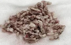 Giải thoát cơn ác mộng tiểu đêm, tiểu khó nhờ kỹ thuật xâm lấn tối thiểu