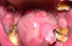 Ung thư khoang miệng: Các biểu hiện ban đầu thường gặp