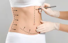Hút mỡ siết eo 3 điểm - Bí quyết sở hữu vòng eo "con kiến"