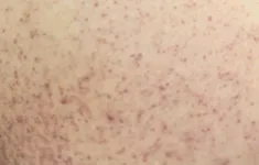 Cô gái 21 tuổi suýt mất mạng vì sốc sốt xuất huyết Dengue nặng