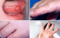Hải Dương: Tăng ca tay chân miệng, cảnh báo biến chứng do điều trị tại nhà kéo dài