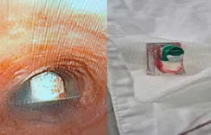Hóc vỏ thuốc chưa bóc: Cảnh báo tai nạn đường thở nguy hiểm