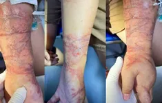 Cảnh báo mùa du lịch biển: Viêm da tiếp xúc do sứa biển