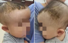 Bé 7 tháng tuổi bị tụ máu đầu do ngã giường