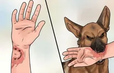 Bé trai mắc bệnh dại sau vết cắn tưởng đã lành