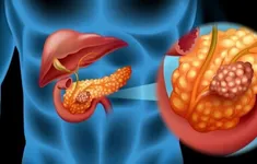 Phát hiện ung thư tụy giai đoạn cuối từ biểu hiện đau bụng kéo dài