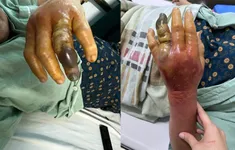 Nữ bệnh nhân hoại tử bàn tay vì vi khuẩn "ăn thịt người" từ gai cá ba gai