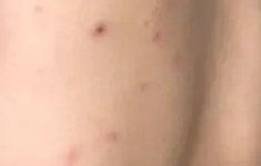 Cứu sống bé 10 tuổi bị thủy đậu biến chứng viêm não