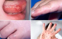 TP Hồ Chí Minh: Số ca mắc bệnh tay chân miệng tiếp tục tăng
