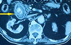 Tắc ruột do sỏi túi mật: Biến chứng nguy hiểm ít ai ngờ