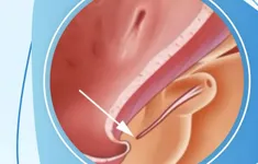 Lỗ tiểu thấp ở trẻ em: 5 dấu hiệu cha mẹ không nên bỏ qua