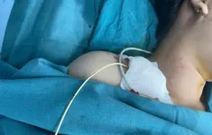 Viêm cơ tim cấp sau sinh: Sản phụ sống sót nhờ can thiệp kịp thời