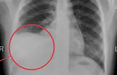 Cảnh báo tràn dịch màng phổi ở trẻ: Nguy hiểm nếu chậm phát hiện