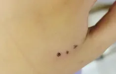 Vết cắn nhỏ - hiểm họa lớn từ chuột