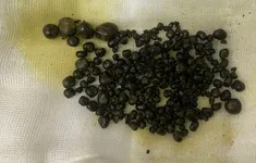 Gần 400 viên sỏi "chen chúc" trong túi mật nữ bệnh nhân 47 tuổi