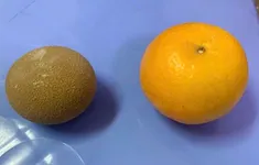 Lấy sỏi bàng quang to như quả cam khỏi cơ thể người đàn ông 69 tuổi