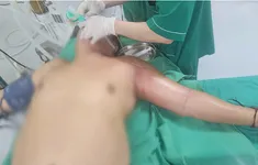 Hoại tử cánh tay vì tự tiêm mật gấu chữa bệnh tại nhà