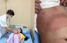 Phú Thọ: 16 trẻ mắc ban nhiễm khuẩn, phụ huynh cần cảnh giác