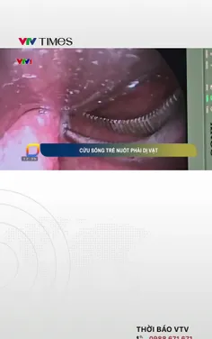 Cứu sống bé trai nuốt phải nhiều viên nam châm