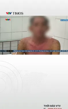 Cứu người dị ứng nghiêm trọng với thuốc nhỏ mắt