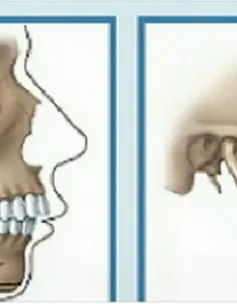 Trẻ em niềng răng tốt nhất ở tuổi 12