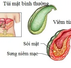 Chớ xem thường triệu chứng viêm túi mật