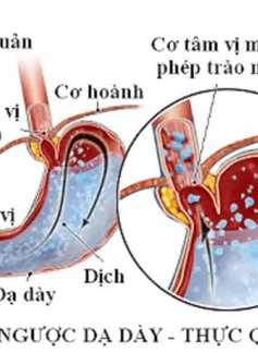 Tìm hiểu về bệnh trào ngược dạ dày - thực quản