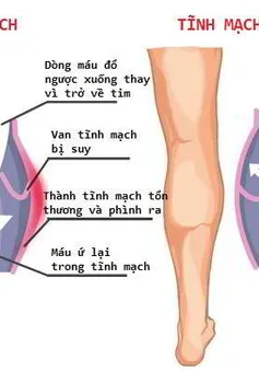 Suy tĩnh mạch mạn tính - bệnh không đơn giản