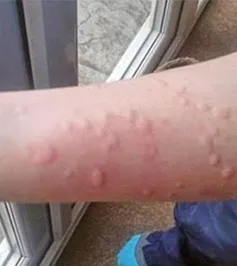 Phòng và điều trị bệnh ngoài da do nhiễm virus