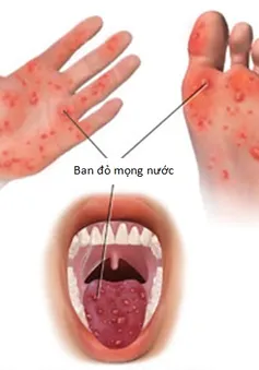 Số ca bệnh tay chân miệng tăng mạnh ở ĐBSCL