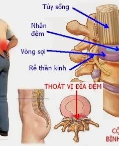 Điều trị thoát vị đĩa đệm hiệu quả bằng Đông y