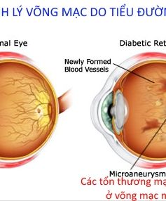 Tìm hiểu bệnh võng mạc do đái tháo đường