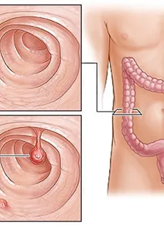 Phương pháp điều trị bệnh polyp đại tràng