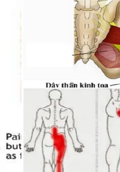 Các biện pháp chữa đau lưng, đau thần kinh tọa do thoát vị đĩa đệm