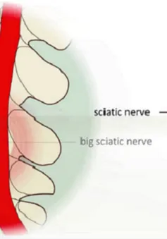 Phát hiện sớm và điều trị bệnh đau lưng, đau thần kinh tọa