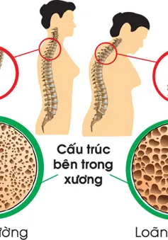 Hướng dẫn chế độ dinh dưỡng cải thiện bệnh loãng xương