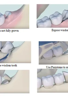 Infographics: Những điều bạn nên biết về răng khôn