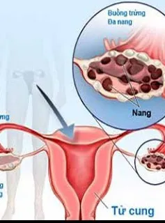 Điều trị hội chứng u đa nang buồng trứng