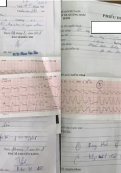 Cứu sống một bệnh nhân ngừng tuần hoàn hô hấp do hội chứng Brugada