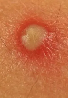 Nguyên nhân gây mụn mủ không đơn giản như bạn nghĩ