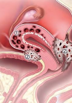 Điều trị lạc nội mạc tử cung trong vô sinh